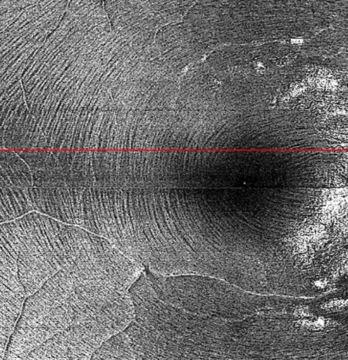 VFT to Support New Non-Invasive Imaging for Tracking Retinal Changes in Young Aniridia Patients Eyes